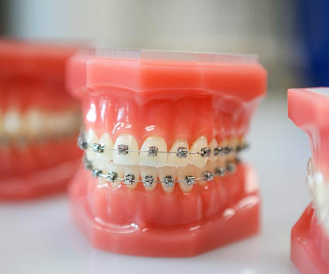 Niềng răng có ảnh hưởng đến thần kinh?